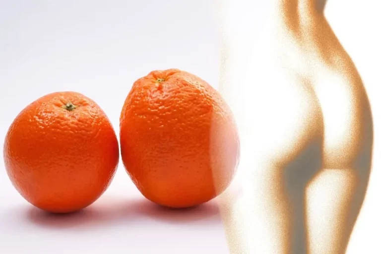 Übersäuerung kann zu Cellulite führen