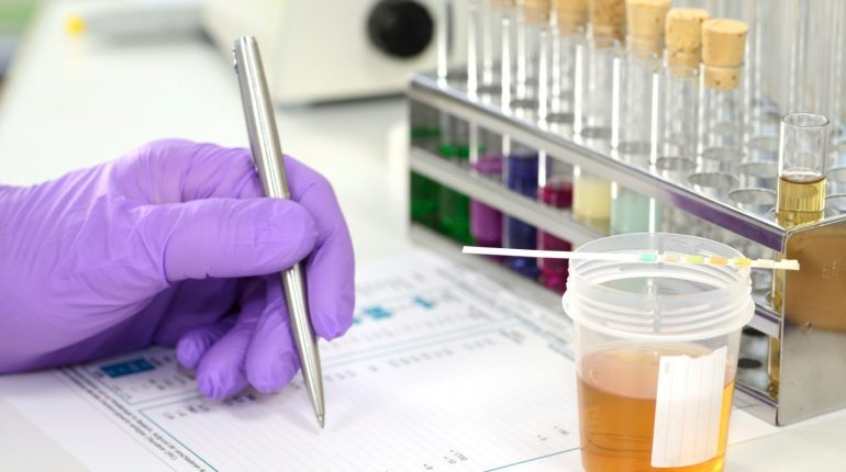 pH-Wert im Urin messen: Urinprobe mit Urin-Teststreifen im Labor